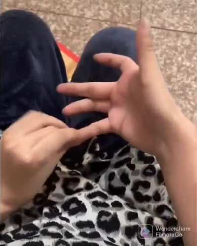 This guy was born with removable fingers