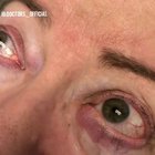 Eyelid pop