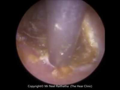 Years of EARWAX Buildup Results In This