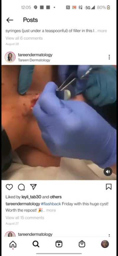 I like how this big cyst on the neck get treated! lol
