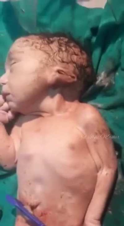 Sirenomelia/ Mermaid Syndrome.