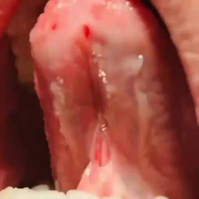 Lingual frenectomy surgery - a treatment for all the people who are hard to pronounce the 