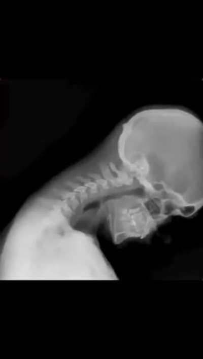 Dynamic Digital Radiography (DDR)