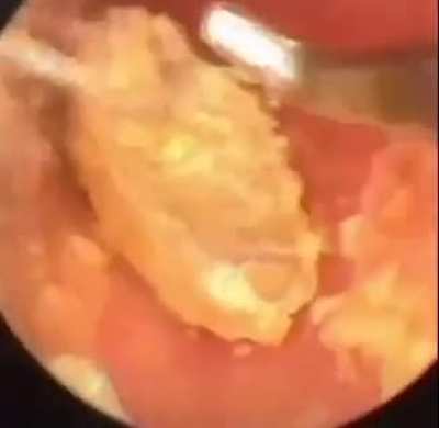 Earwax removal
