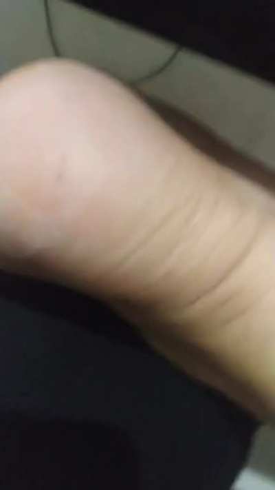 6 days after using salicylic acid patch (Would use gloves next time)