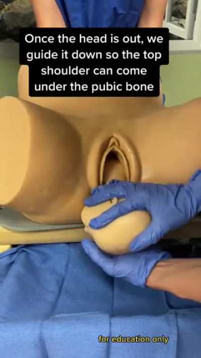 Extracting a baby