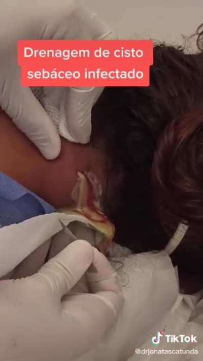 Neck Abscess I&D!