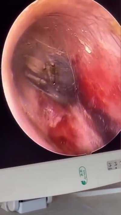 Spider crawls in a guy’s ear while he slept