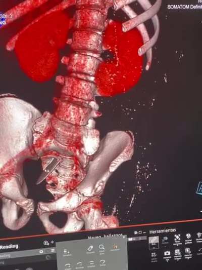 CAT scan of a surf fin in a dudes lower back!