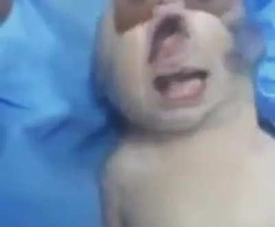 I'm going to hell for this (this baby has kleeblattschädel syndrome)