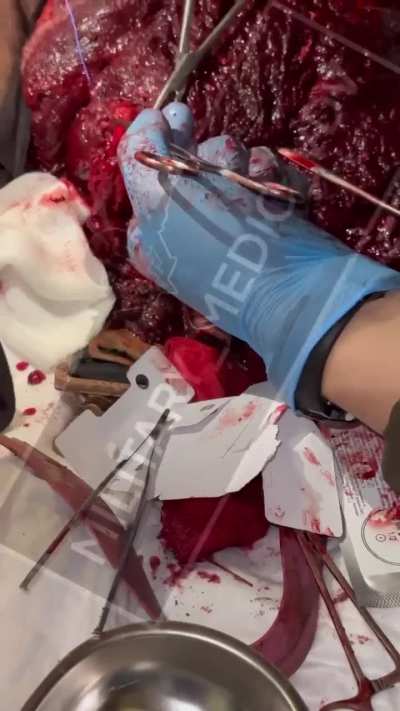 Ru POV: Soldier wounded by close explosion of a 120 mm mortar shell receiveing treatment in field hospital.