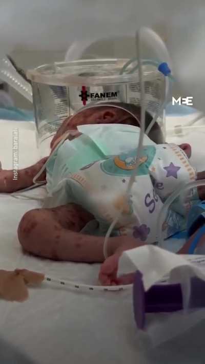 Osama Sahloul, a 20-day-old baby, is one of thousands of Palestinians battling a severe outbreak of chickenpox in Gaza.