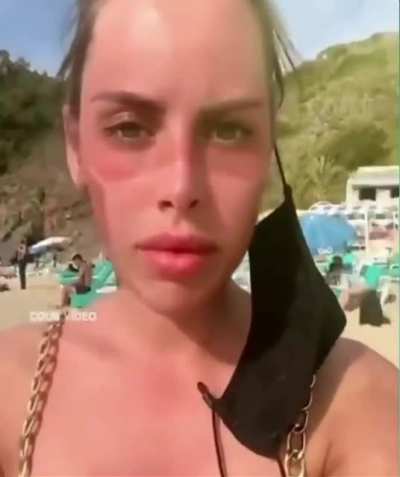 Sun burn