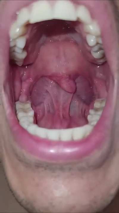 Moving tongue behind the uvula (hypermobility)