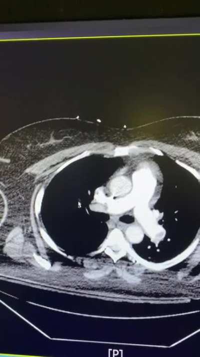 D Dimer 3200; hypoxia pretty bad PE.