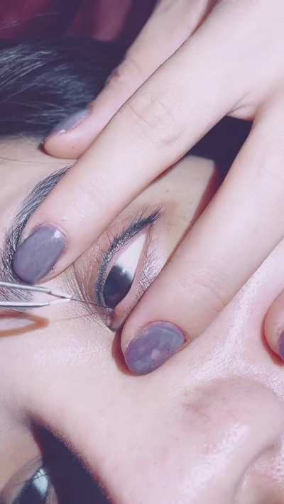 Plucking hair from tear duct