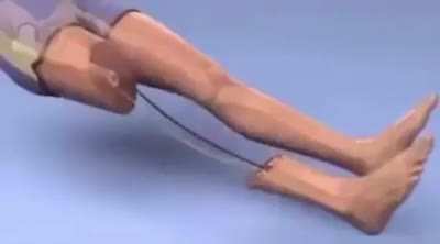 correction surgery