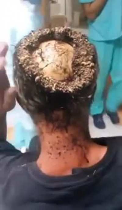 Maggot infested scalp with exposed skull
