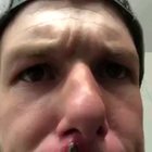 Guy pulls a huge thing out of his face