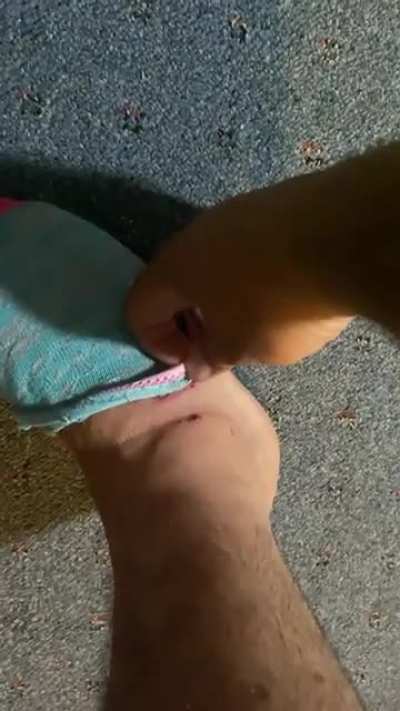 Scab formed on foot and stuck to sock