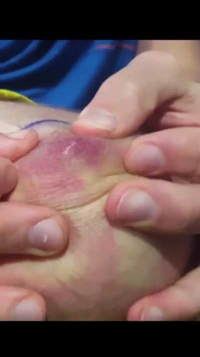 Man and Son Treat Sand Fly Bite