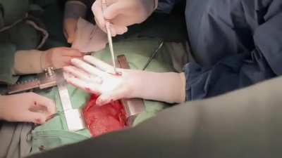 Doctor Todurov, the head of the Heart Institute of Ukraine, extracts a 7.62 caliber bullet from the heart of a Ukrainian soldier. The person survived and is recovering.