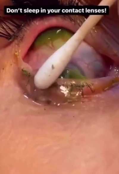 She slept with contact lenses and woke up without. Now she has found the missing 23.