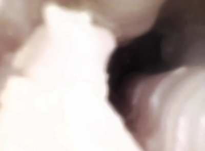 Endoscope view of my last session!