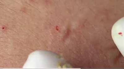 Black heads