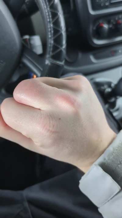 Returning to the gym after middle finger amputation