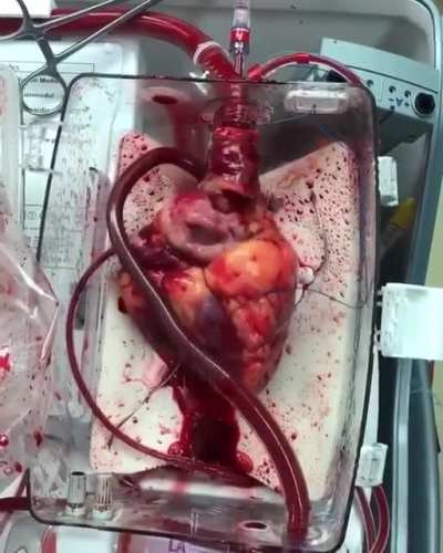Video of a beating heart awaiting transplant!! This donor heart is using the Organ Transplant System, Heart<wbr>-in-a<wbr>-Box.