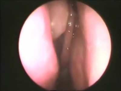 Nasal maggots
