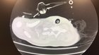 Incredible chest CT of a COVID case intubated for over 25 days, now awake and alert on minimal vent settings. We’ve never seen anything like this.