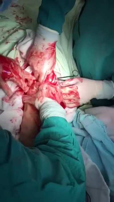 A male patient has an impre<wbr>ssive<wbr>ly-ma<wbr>ssive foreign body removed