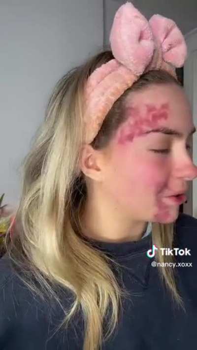 TikToker Nancy has a rare skin condition that causes random flare-ups, here is one caught on camera from the onset.
