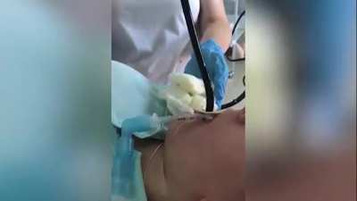 Извлечение живой змеи из девушки в больнице под наркозом без операции. Заползла, когда та спала на природе с открытым ртом.