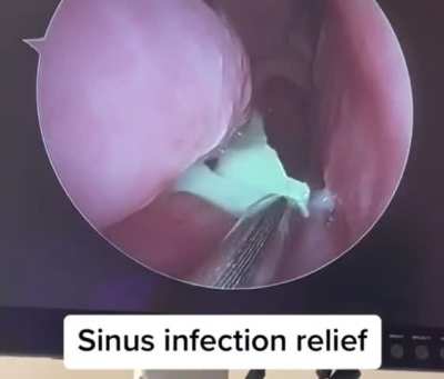 DOC CLEANING SINUS .IMAGINE  THE RELIEF PATIENT MUST HAVE GOT!!