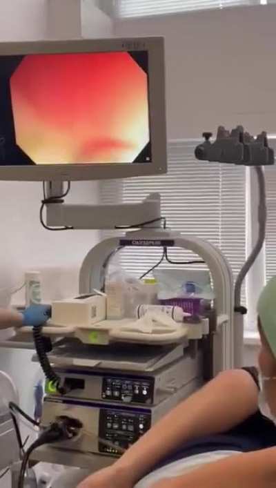Cucumber removed from Anus Cavity