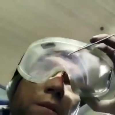The proof that safety glasses are worth wearing.