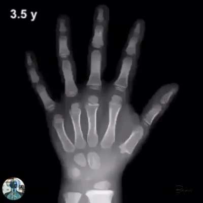 Bone Age
