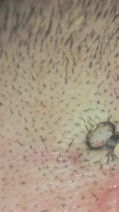 scavenged these on my bf's scalp