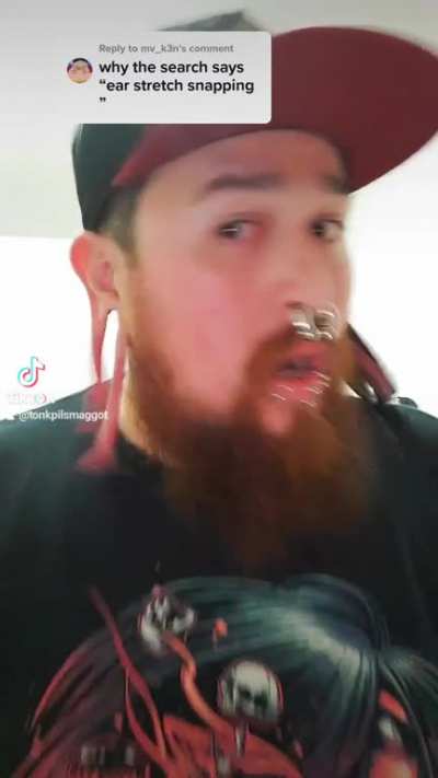 When ear stretching goes wrong