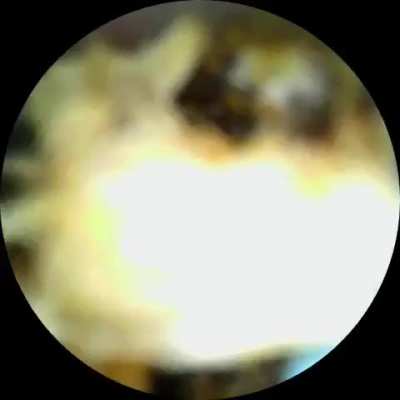 Insane marble of earwax I pulled out of my bf's ear (closeup at the end) He'd had tinnitus for years and this instantly cured it.