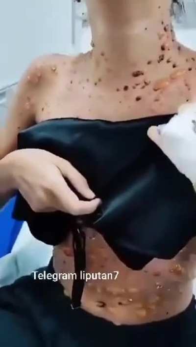 Viruela del mono? 