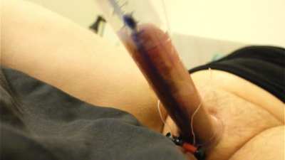 HFO in the tube