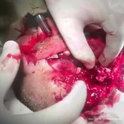 Gunshot injury to the face and mandibular recon<wbr>struc<wbr>tion. In such cases, maxillofacial surgeons prefer closing the soft tissues after debridement without replacing the lost bone