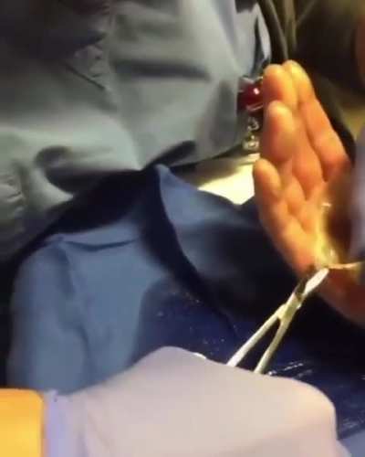 Blistering of the palm of the hand after a burn