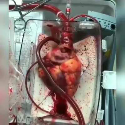 Human heart waiting for trans<wbr>plant<wbr>ation