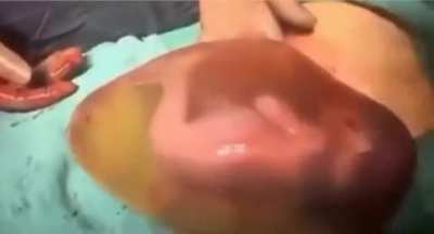 Surgeons successfully remove amniotic sac from mother during surgery.
