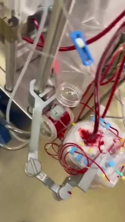 A heart which is gonna get transplanted